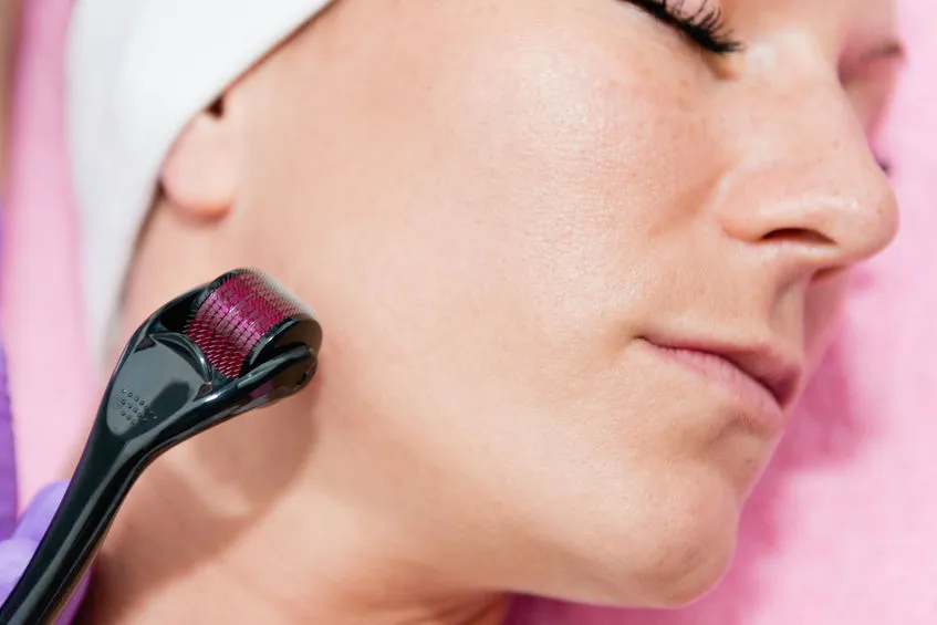 Needling Skin – Microneedling bei BELLESOI Leipzig
