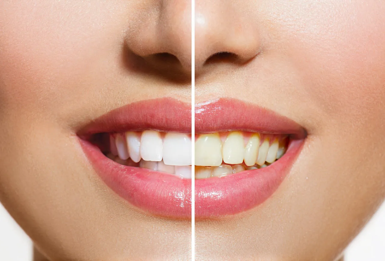 Zahnbleaching – Kosmetisches Zahnbleaching bei BELLESOI Leipzig